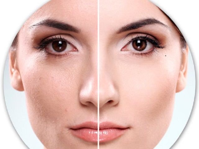 Радиочестотен биолифтинг за лице 40+ - ваучер за козметична процедура